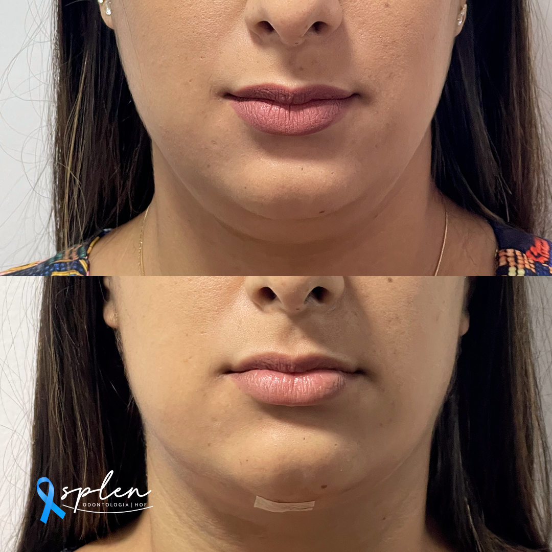 Resultado de mais uma Lipo de Papada!
